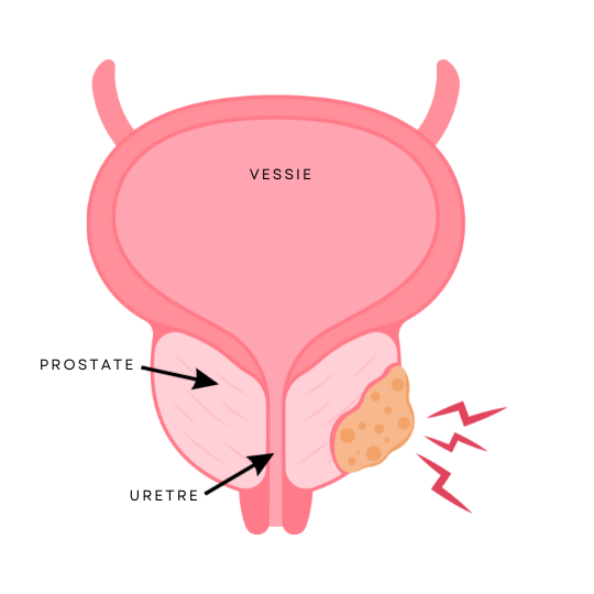 anatomie-prostate-cancer-pharmacie-villelongue-salanque